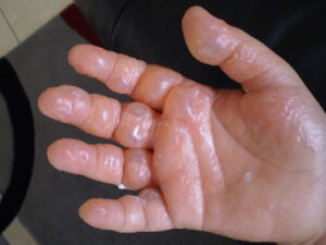 Phytophotodermatitis, condition, cocktails